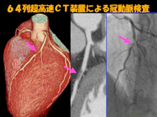 心臓CT検査