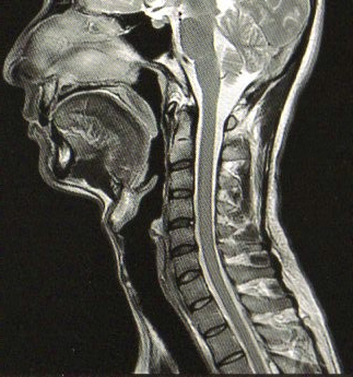 頸椎MRI